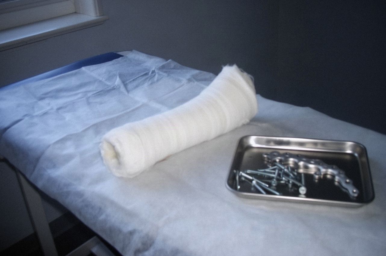 Gips czy operacja: od czego zależy leczenie złamania